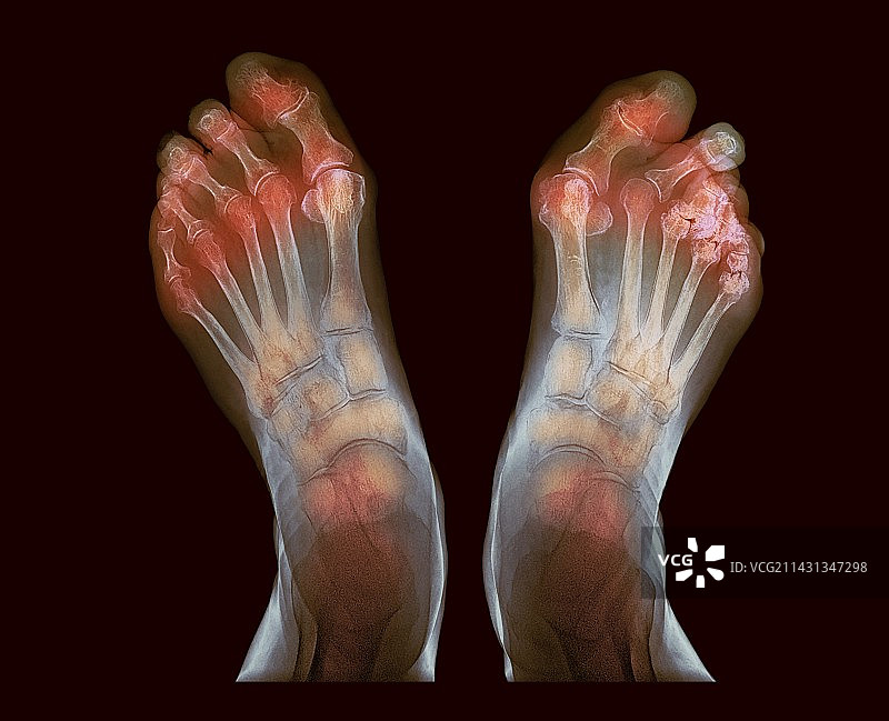 类风湿性关节炎彩色X光片图片素材