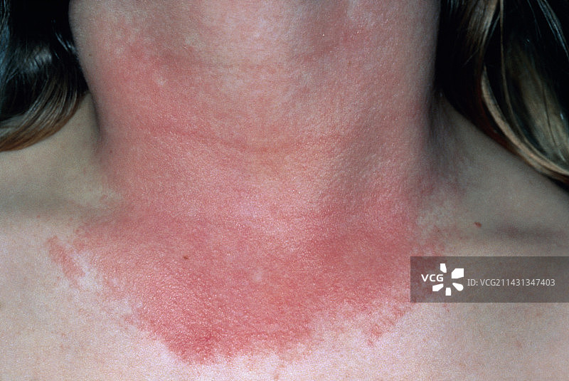 女性颈部的光敏性皮疹图片素材
