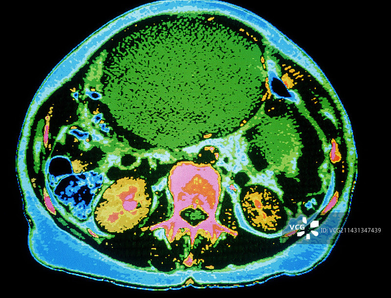 卵巢癌彩色CT扫描图片素材