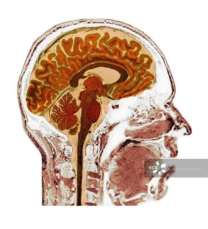 正常人脑部核磁共振扫描图片素材