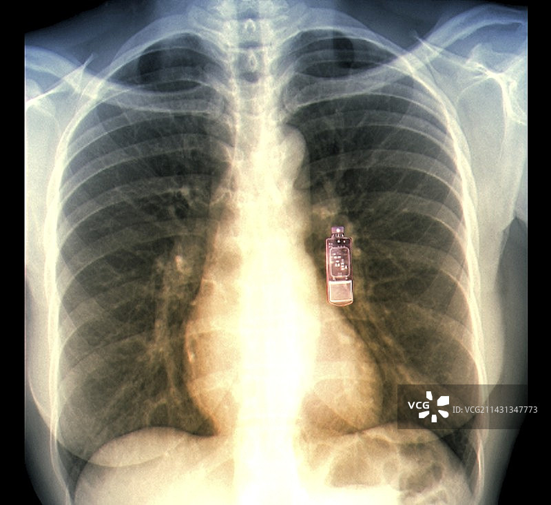 心脏监护设备、胸部X光片图片素材