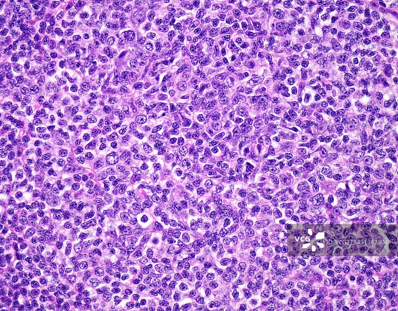 滤泡性淋巴瘤显微照片图片素材
