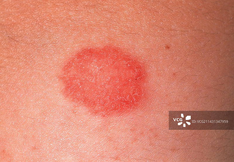 光敏性药物反应图片素材