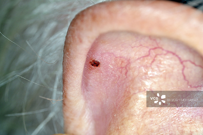 皮肤癌图片素材