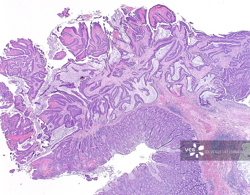 结肠癌显微照片图片素材