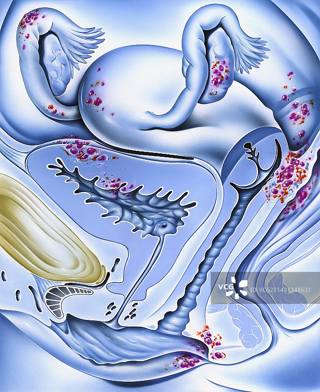 子宫内膜异位图片素材