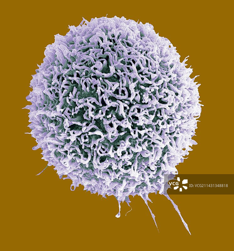 乳腺癌细胞扫描电镜图图片素材