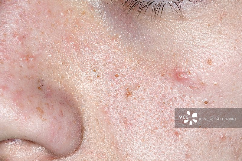 面部的寻常痤疮图片素材