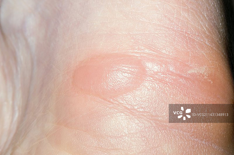 新鞋磨出的脚后跟水泡图片素材