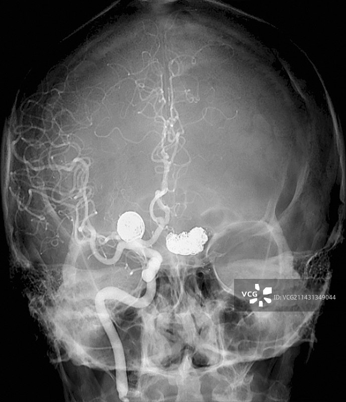 动脉瘤治疗血管造影图片素材