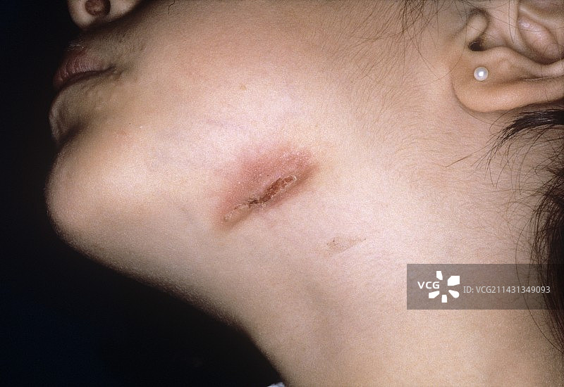 唾液腺感染图片素材