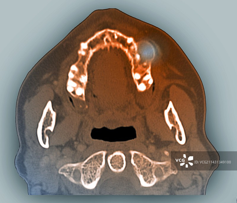 颌骨巨细胞肉芽肿CT扫描图片素材