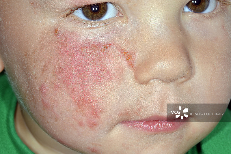 面部蜂窝组织炎图片素材