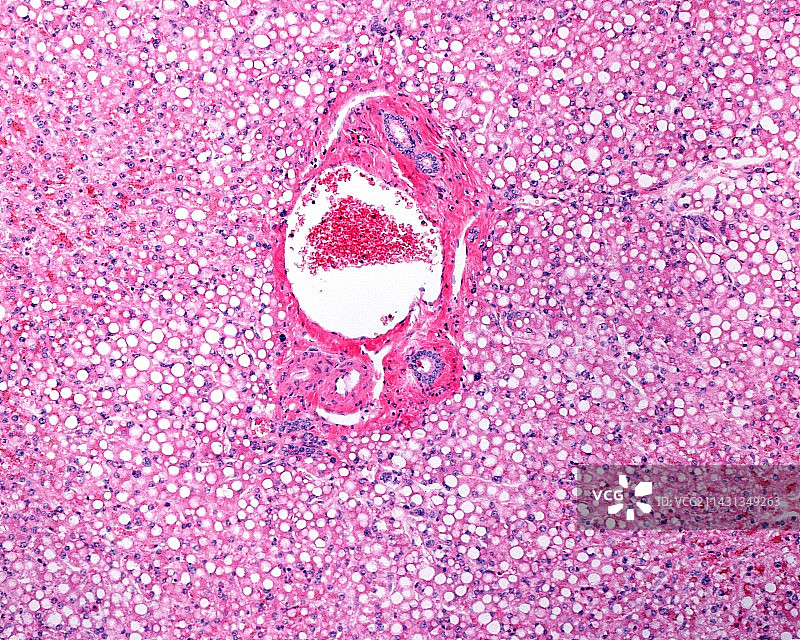 脂肪肝，光学显微照片图片素材