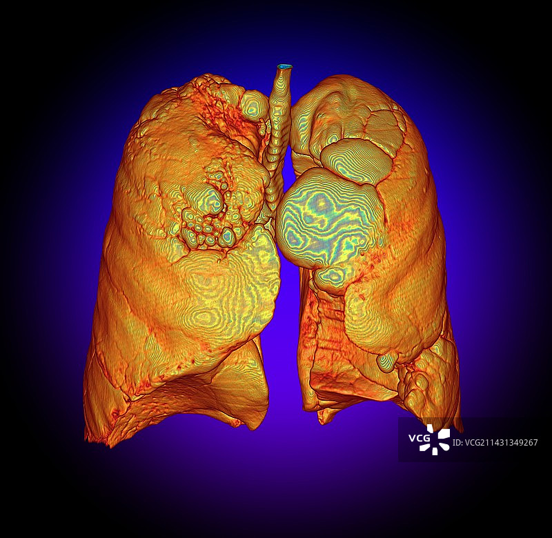 吸烟者肺部与肺气肿，3D CT扫描图片素材
