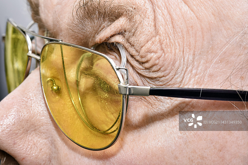 患有上睑下垂的眼睛图片素材