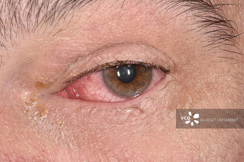 艾滋病毒患者的细菌性结膜炎图片素材