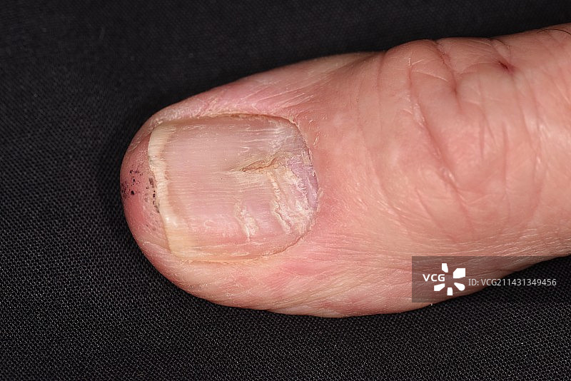 营养不良的指甲图片素材