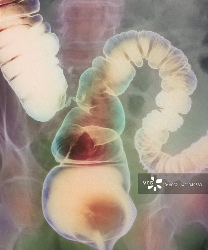 肠易激综合征X光片图片素材