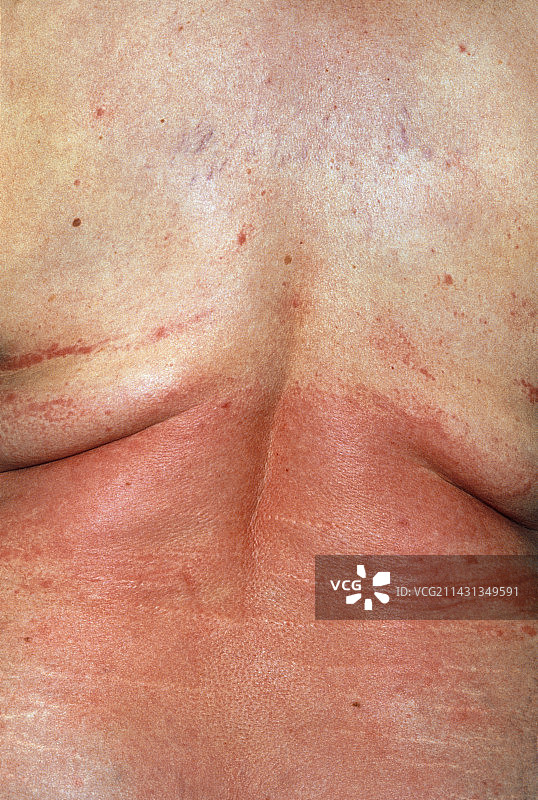 药物过敏皮疹图片素材