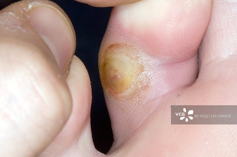 脚趾上的老茧感染图片素材