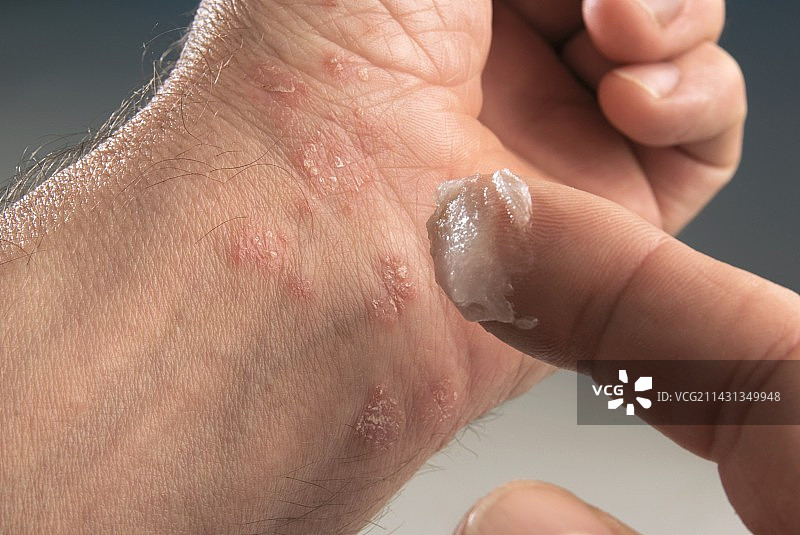 银屑病治疗图片素材