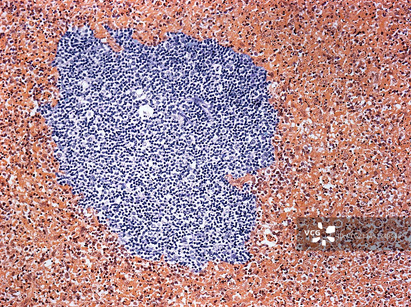 菊池-藤本病图片素材