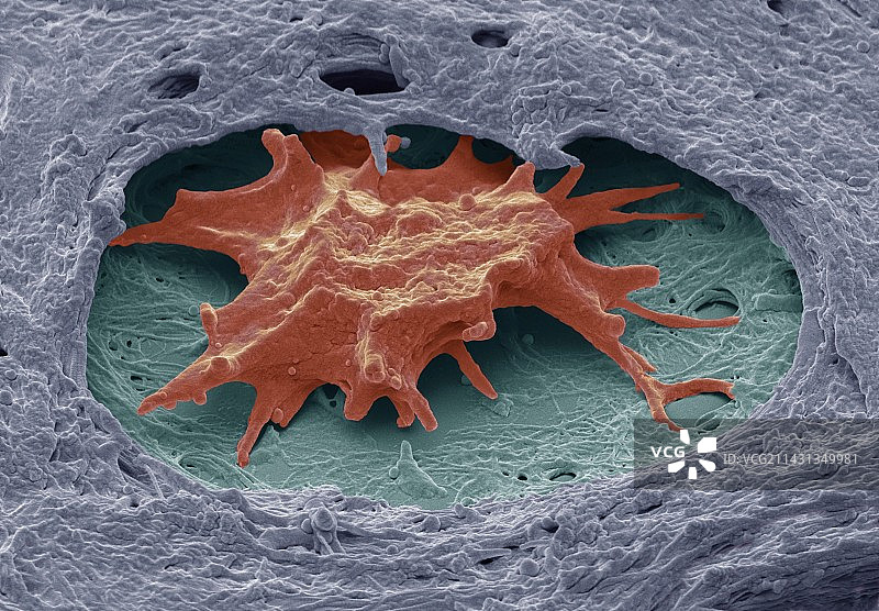 卵巢癌扫描电镜图片素材