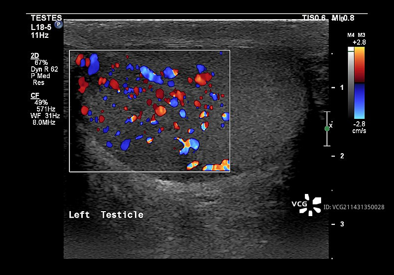 睾丸癌超声波扫描图片素材