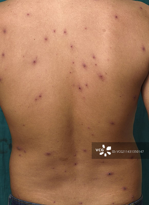 成年男性患水痘图片素材