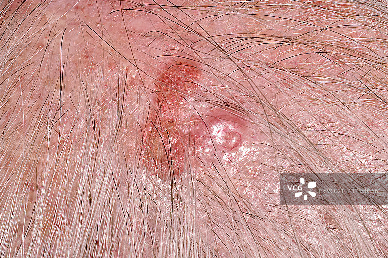 结节性基底细胞癌图片素材