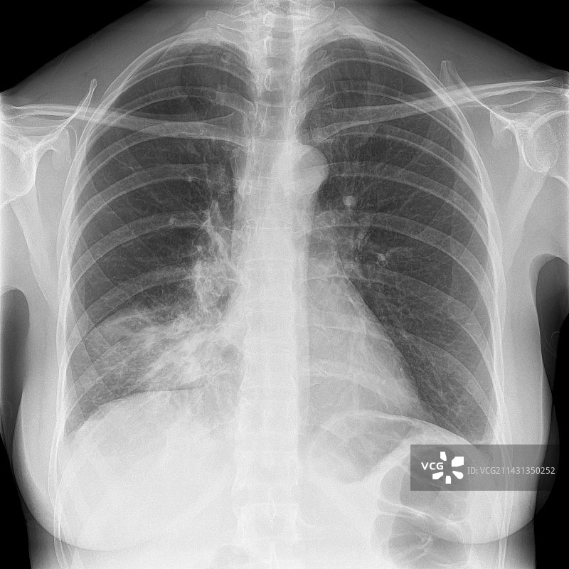 肺炎X光片图片素材