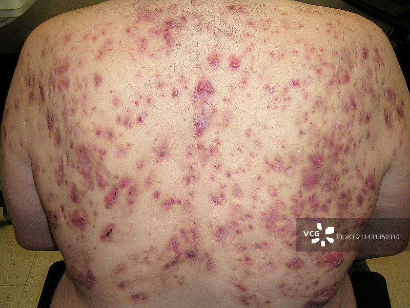 治疗后的聚合性痤疮和化脓性汗腺炎图片素材