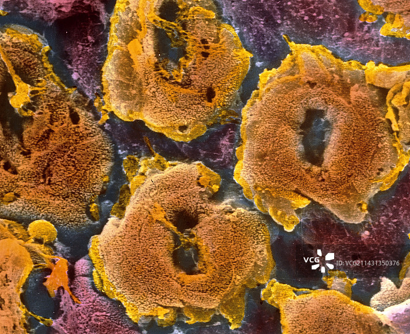 溃疡性结肠炎的人类结肠扫描电镜图图片素材