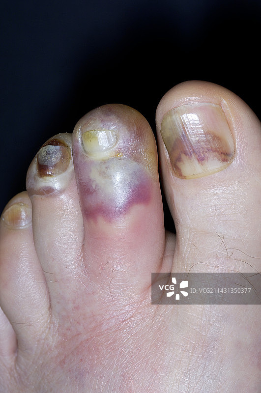 趾部蜂窝组织炎图片素材