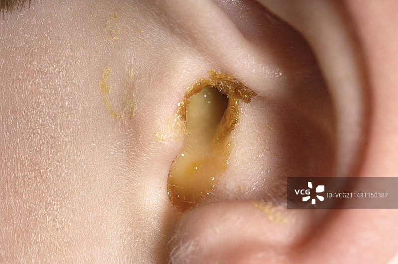 耳朵感染图片素材