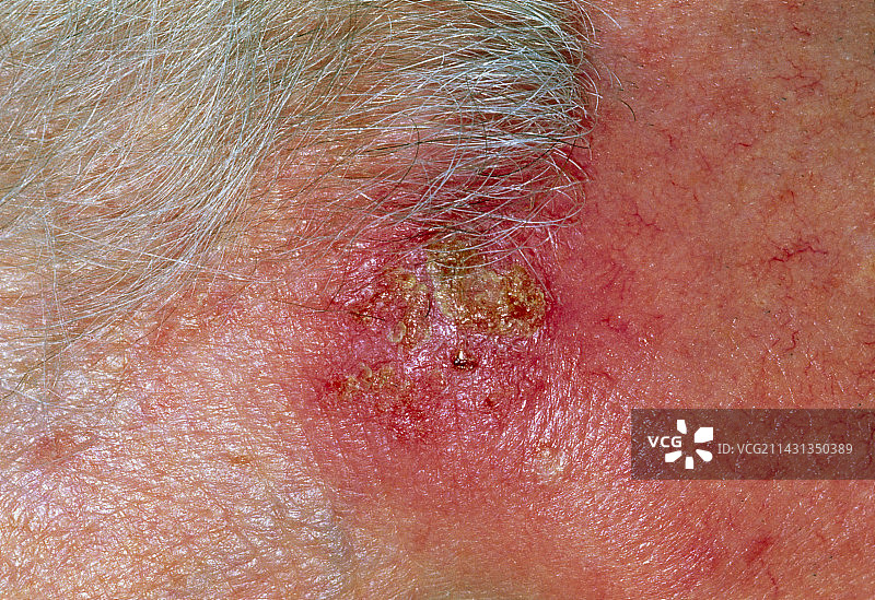 日光性角化病图片素材