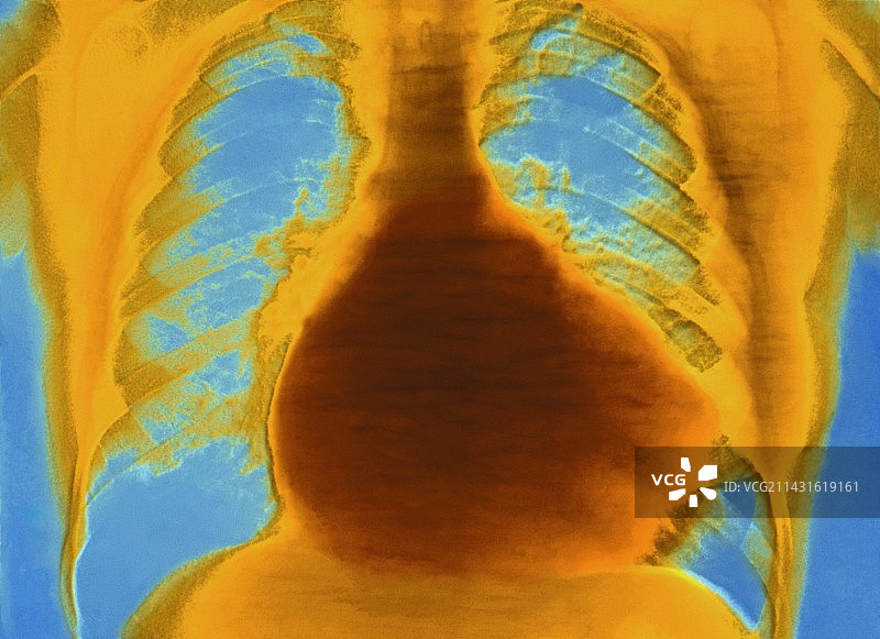 心脏疾病图片素材