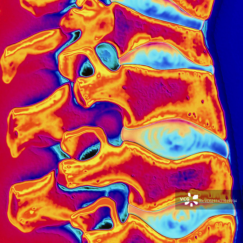 显示骨质疏松症的人体脊柱彩色X光片图片素材