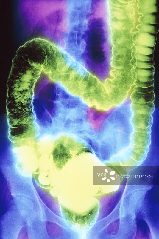 溃疡性结肠炎双重对比X射线图片素材