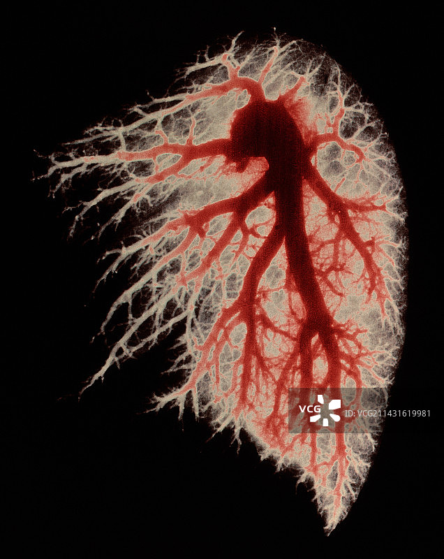 肺动脉的彩色血管造影图图片素材