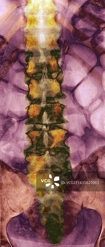 继发性骨癌X光片图片素材