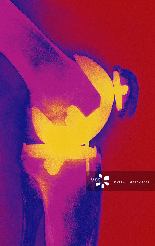 假肢膝盖图片素材