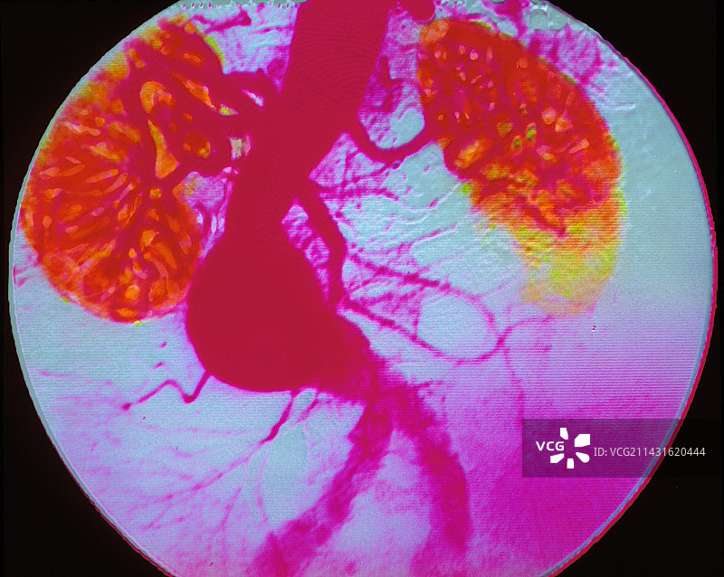 显示动脉瘤的动脉造影图图片素材