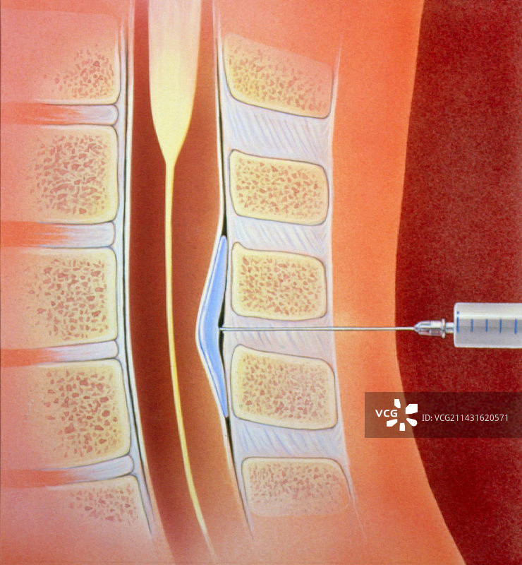 脊柱硬膜外麻醉图片素材
