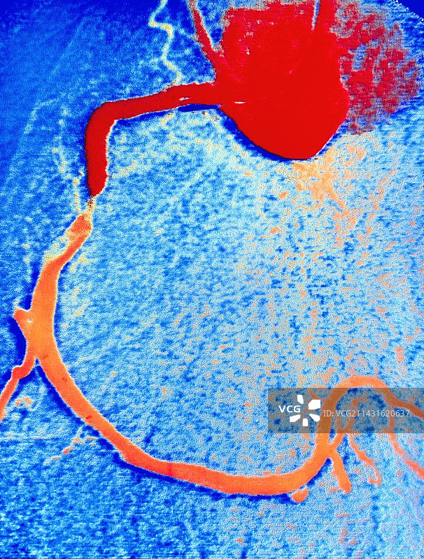 血管成形术前冠状动脉血管造影图片素材