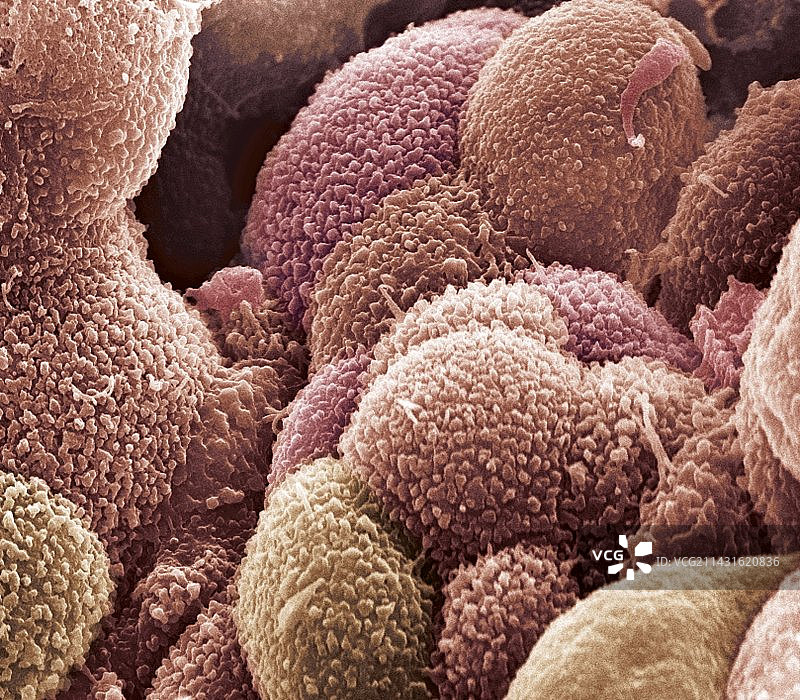 卵巢癌细胞，扫描电子显微镜图片素材