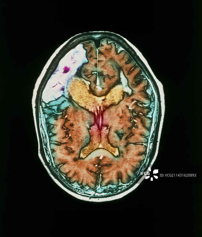 脑卒中核磁共振扫描图片素材