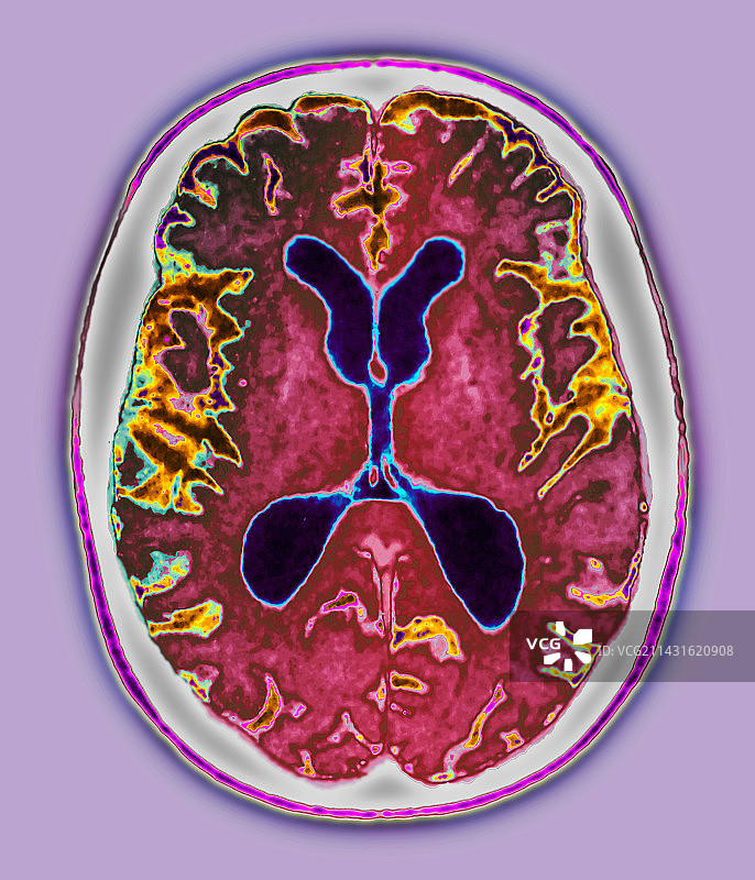 阿尔茨海默病核磁共振扫描图片素材