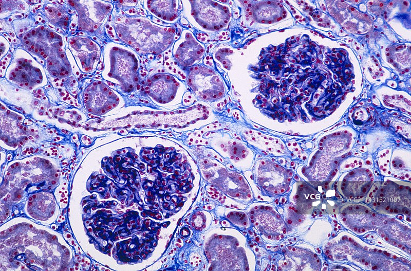 显示白血病的肾脏切片显微镜照片图片素材